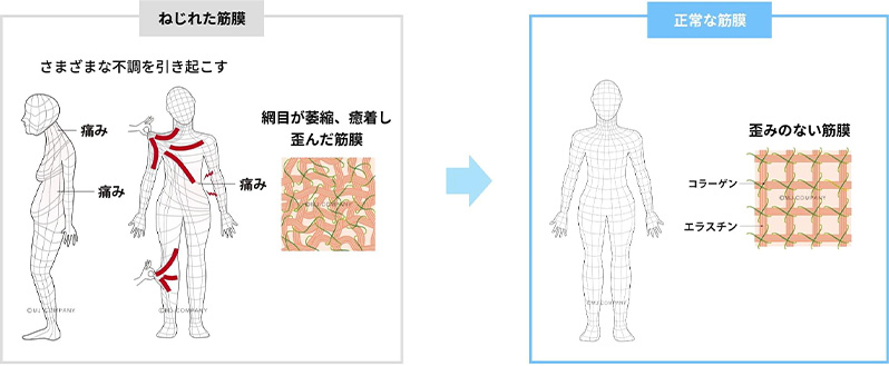 ねじれた筋膜と正常な筋膜