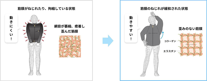 ねじれた筋膜と正常な筋膜